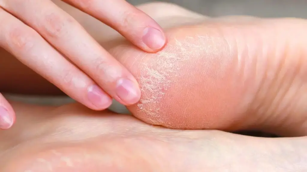 Pourquoi les podologues conseillent d'appliquer de la crème à l'urée sur des pieds secs plutôt qu'humides
